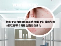 他扎罗汀和维a酸银屑病 他扎罗汀凝胶与维a酸软膏哪个更适合脂溢性角化