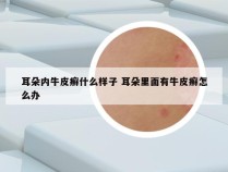 耳朵内牛皮癣什么样子 耳朵里面有牛皮癣怎么办