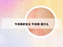 牛皮癣的含义 牛皮癣 是什么