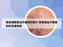 银屑病那里治疗最好的地方 银屑病治疗那里的好百度贴吧