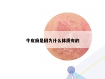 牛皮癣是因为什么体质有的
