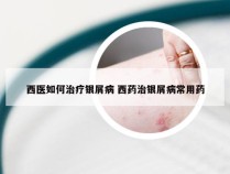 西医如何治疗银屑病 西药治银屑病常用药