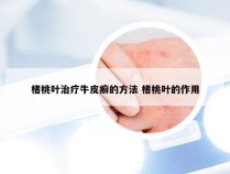 楮桃叶治疗牛皮癣的方法 楮桃叶的作用