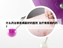 什么药冶银屑病最好的医院 治疗银屑病的药?