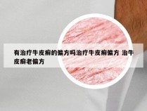 有治疗牛皮癣的偏方吗治疗牛皮癣偏方 治牛皮癣老偏方
