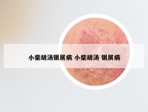 小柴胡汤银屑病 小柴胡汤 银屑病