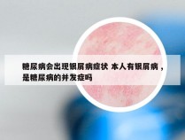 糖尿病会出现银屑病症状 本人有银屑病 ,是糖尿病的并发症吗
