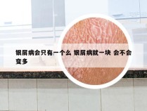 银屑病会只有一个么 银屑病就一块 会不会变多