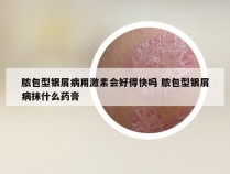 脓包型银屑病用激素会好得快吗 脓包型银屑病抹什么药膏