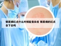 银屑病红点什么时候能变白皮 银屑病的红点会下去吗