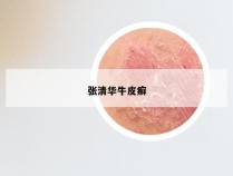张清华牛皮癣