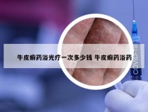 牛皮癣药浴光疗一次多少钱 牛皮癣药浴药