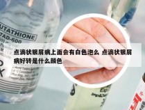 点滴状银屑病上面会有白色泡么 点滴状银屑病好转是什么颜色