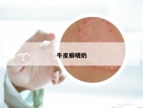 牛皮癣喂奶