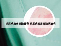 银屑病地米硼酸乳膏 银屑病能用硼酸洗液吗
