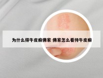 为什么得牛皮癣佛家 佛家怎么看待牛皮癣