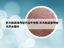 彭大脑袋祖传秘方治牛皮癣 彭大脑袋祖传秘方药水图片