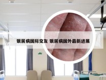 银屑病国际交友 银屑病国外最新进展