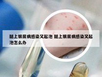 腿上银屑病感染又起泡 腿上银屑病感染又起泡怎么办
