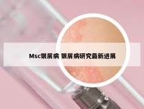 Msc银屑病 银屑病研究最新进展