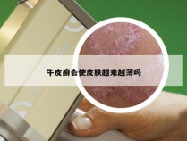 牛皮癣会使皮肤越来越薄吗