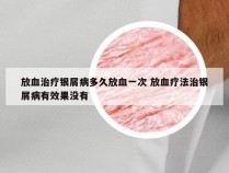 放血治疗银屑病多久放血一次 放血疗法治银屑病有效果没有