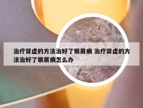 治疗肾虚的方法治好了银屑病 治疗肾虚的方法治好了银屑病怎么办