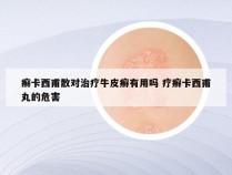 癣卡西甫散对治疗牛皮癣有用吗 疗癣卡西甫丸的危害