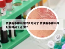皮肤癣不疼不痒好长时间了 皮肤癣不疼不痒好长时间了还没好