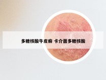 多糖核酸牛皮癣 卡介菌多糖核酸