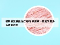 银屑病复发能治疗好吗 银屑病一般复发要多久才能治愈