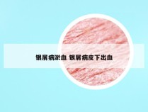 银屑病淤血 银屑病皮下出血