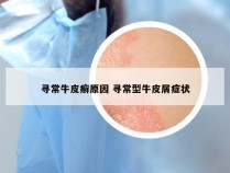 寻常牛皮癣原因 寻常型牛皮屑症状