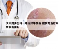 天天跑步坚持一年治好牛皮癣 跑步对治疗银屑病有用吗
