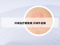 兴城治疗银屑病 兴城牛皮癣