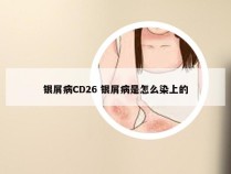 银屑病CD26 银屑病是怎么染上的