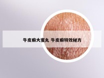 牛皮癣大蜜丸 牛皮癣特效秘方