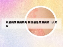 银屑病艾滋病前兆 银屑病是艾滋病的什么阶段
