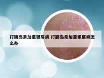 打胰岛素加重银屑病 打胰岛素加重银屑病怎么办