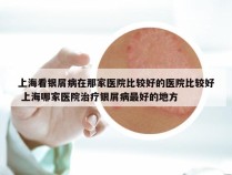上海看银屑病在那家医院比较好的医院比较好 上海哪家医院治疗银屑病最好的地方