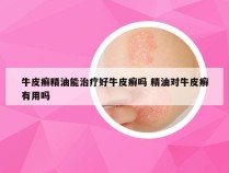 牛皮癣精油能治疗好牛皮癣吗 精油对牛皮癣有用吗