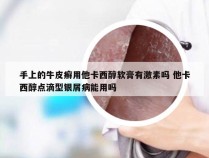 手上的牛皮癣用他卡西醇软膏有激素吗 他卡西醇点滴型银屑病能用吗