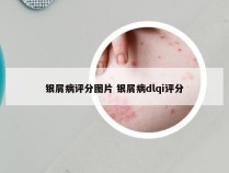 银屑病评分图片 银屑病dlqi评分