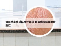 银屑病皮肤泛红用什么药 银屑病皮肤光滑特别红