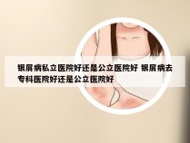 银屑病私立医院好还是公立医院好 银屑病去专科医院好还是公立医院好