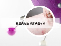 银屑病治法 银屑病最有效