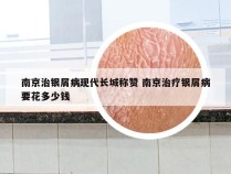 南京治银屑病现代长城称赞 南京治疗银屑病要花多少钱