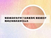 银屑病没好光疗停了会再爆发吗 银屑病光疗期间还有新的皮疹怎么办