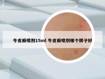 牛皮癣喷剂15ml 牛皮癣喷剂哪个牌子好