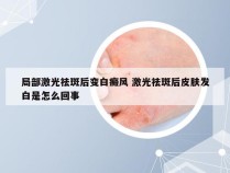局部激光祛斑后变白癜风 激光祛斑后皮肤发白是怎么回事